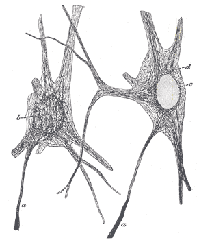 Diagram of ischemic stroke from a clot blocking cerebral artery