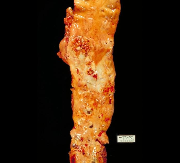 Autopsy specimen of aorta with atherosclerotic plaques