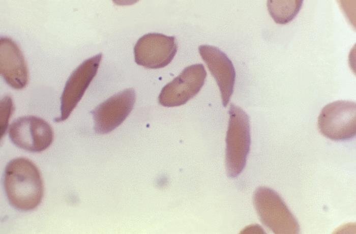 Sickle cell blood smear