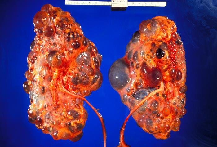 Polycystic kidney gross pathology specimen